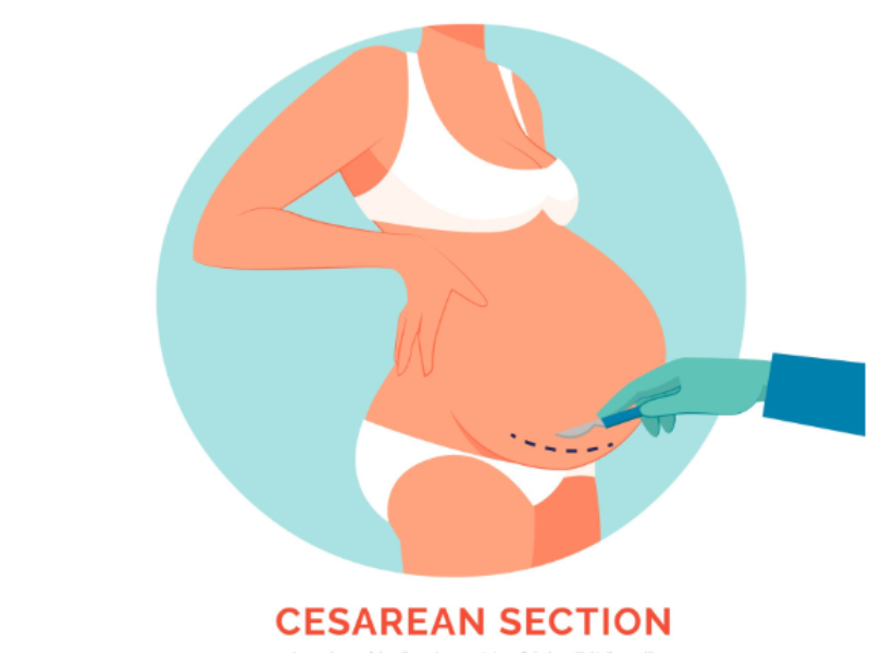C-Section Delivery in Kanpur by Dr. Sandhya Gupta