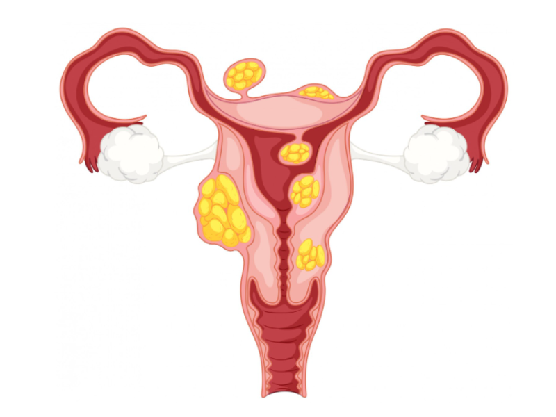 Dr. Sandhya Gupta providing PCOD treatment in Kanpur