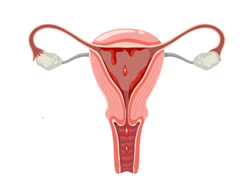 Menorrhagia Treatment in Kanpur by Dr. Sandhya Gupta