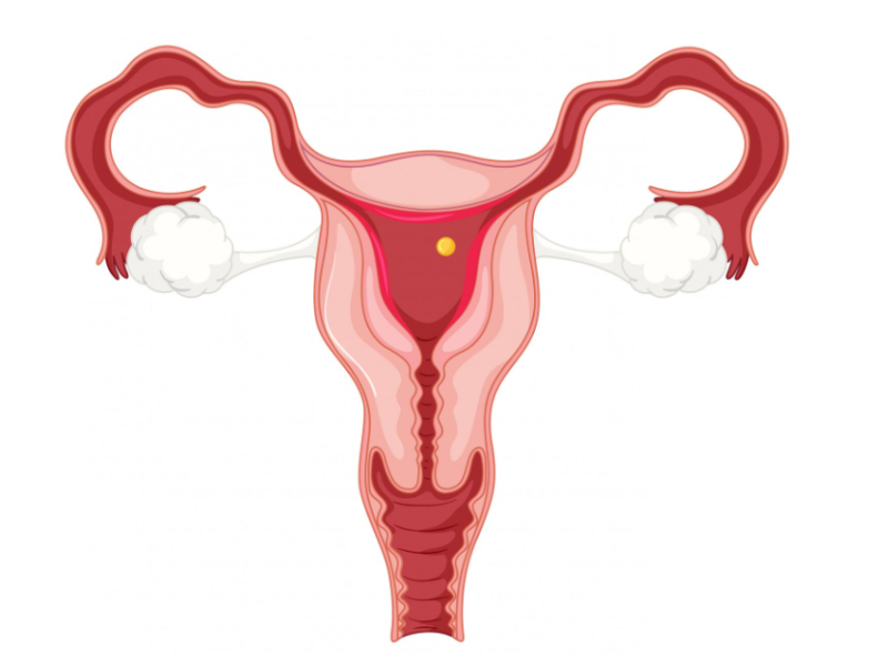 Cervical fibroids illustration showing the uterus and cervix